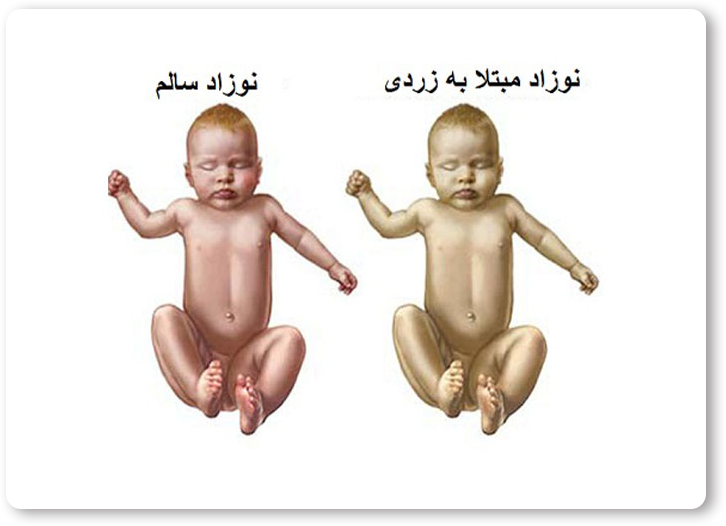 درمان قطعی زردی نوزادان-https://dr-hermanmoghadam.com