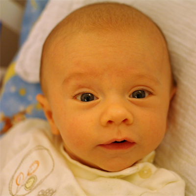 تفاوت زردی فیزیولوژیک و پاتولوژیک در نوزادان